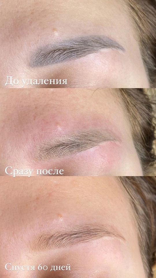 ❗УДАЛЕНИЕ ТАТУАЖА❗➡️ [id812844182|@permanentdon]
✅ быстро (длительность